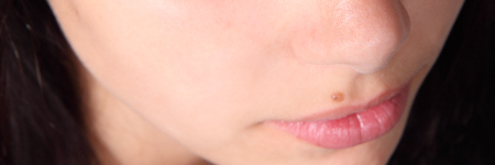 眉毛ニキビをしっかり治療する方法