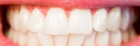歯垢と歯石の違い